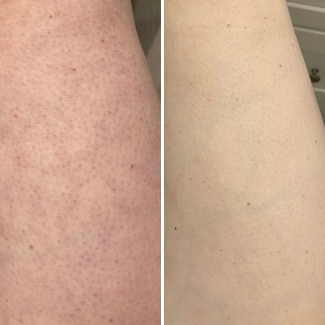 Il segreto per eliminare definitivamente le gambe a fragola
