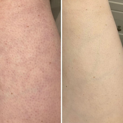 Il segreto per eliminare definitivamente le gambe a fragola