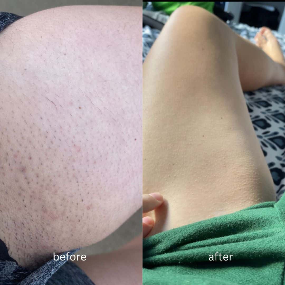 Il segreto per eliminare definitivamente le gambe a fragola