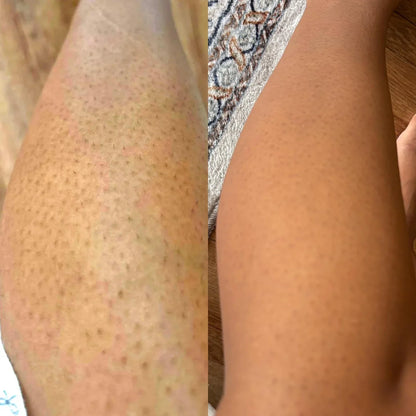 Il segreto per eliminare definitivamente le gambe a fragola